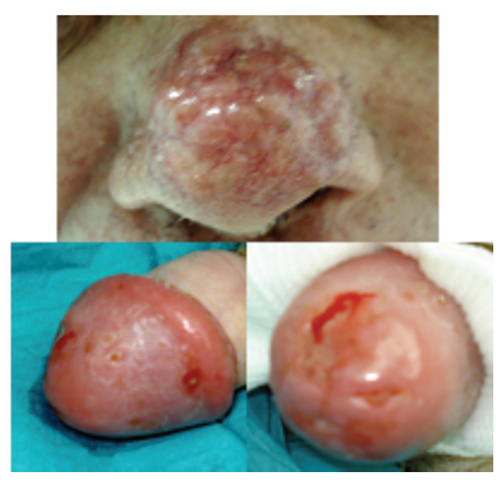 Skin Lesions On Penis 102