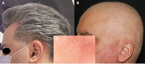 Alopecia areata after COVID- 19 vaccination: Two cases and review of the  literature | Dermatology Reports