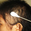 Photograph of application of DPCP on affected scalp